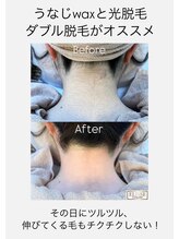 エリス(ELISSE)/うなじwaxと光脱毛のダブル脱毛