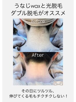 エリス(ELISSE)/うなじwaxと光脱毛のダブル脱毛