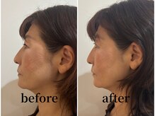 たたら鍼灸整骨院/60代女性　before / after