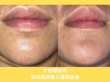 エクレ 柏店(EKURE)/レディース顔脱毛