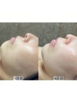 アンドミー 鹿児島中山(&me)/ララピール【艶肌/美白/くすみ】