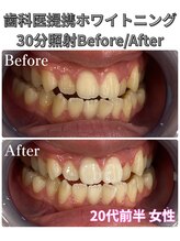 プラチナムビューティ 四条烏丸店(PLATINUM Beauty)/ホワイトニング！Before./After!
