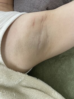 ナノハナ/鹿沼市の全身脱毛のナノハナ