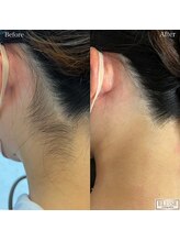 エリス(ELISSE)/えり足脱毛が大人気