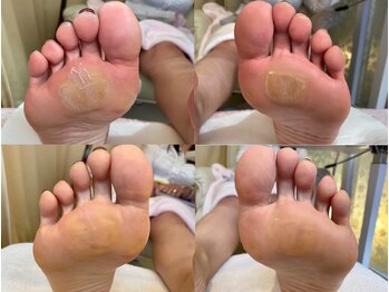 ビサンテ サロン/角質ケア・たこ・ヒ-ルダコ,ケア