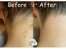 ビビユー(bibi u)/うなじ【WAX脱毛】before after