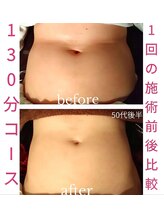 バービーホリック(barbie holic)/１３０分コース　１回の施術前後