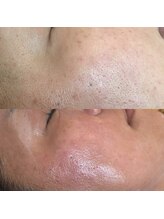 シャルム エスボーテ(charme Esbeaute)/毛穴レスのお肌ハーブピーリング