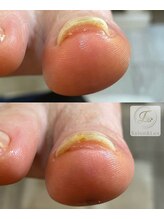 サロン アンド ルクス(Salon & Lux)/巻き爪ケア
