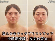 リストアハート(Restore Heart)/お顔がコンパクトに