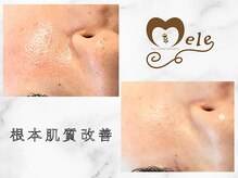 毛穴もこんなに綺麗に♪今まで変化を実感しにくかった方はぜひ！