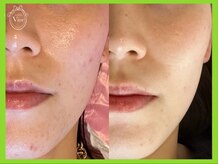 ハーブピーリング 名古屋/剥離なし・肌に優しい天然ハーブ