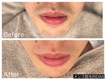 ビダン(BIDAN)/ヒゲ脱毛　BeforeAfter