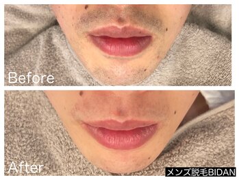 ビダン(BIDAN)/ヒゲ脱毛 BeforeAfter