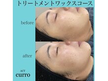 アクト クロ(ACT curro)/【フェイシャル】施術例