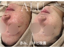 アルフォービューティー 難波店(ALU for beauty)/赤み・ニキビ症例