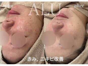 アルフォービューティー 難波店(ALU for beauty)/赤み・ニキビ症例