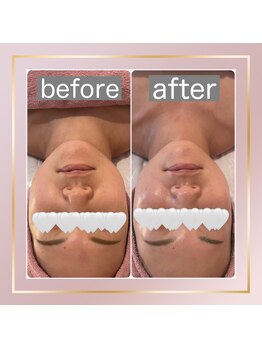 ベルメール(Bellemer)/イラストリアス施術のお客様♪