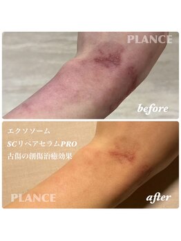 プランス 恵比寿店(PLANCE)/ヒト幹細胞/エクソソーム/恵比寿
