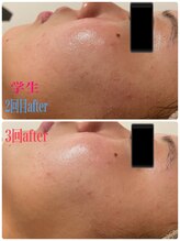 リヤン(Lien)/ニキビのケアにも◎