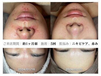 コキュウギンザ スキンケア アンド ヘルスケア(KOKYU GINZA)/スキングローピール5回のお客様