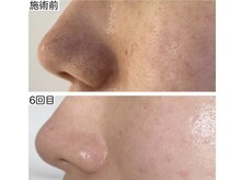 チェルト 鈴鹿店(CERTO)/REVIハーブピーリング効果