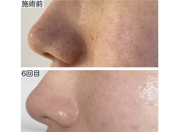 チェルト 鈴鹿店(CERTO)/REVIハーブピーリング効果