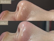 ティーツリー 名古屋 桜山(Tea Tree)/【毛穴ケア・毛穴洗浄】