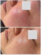 ティンクルホワイト 橿原店/剥離しないハーブピーリング