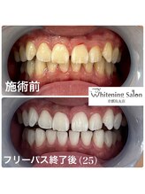 ホワイトニングサロン 京都烏丸店/ホワイトニング施術例