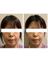 ビーサロン(B-salon)/肌つや/小顔コルギ