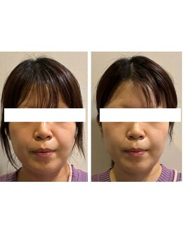 ビーサロン(B-salon)/肌つや/小顔コルギ