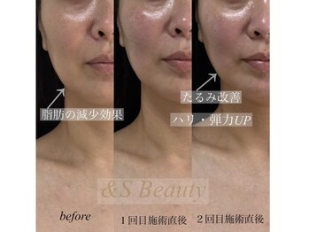 アンドエスビューティ(&S Beauty)の写真/エステ版オンダリフト！！韓国で話題のサーマウェーブで脂肪撃退、たるみケア！肌質まで変わる！