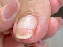 Nailtrimの巻き爪ケア、フットケア、トラブルネイルご相談下さい