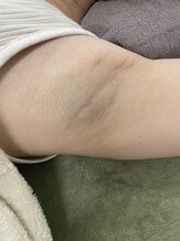 ナノハナ/鹿沼市の全身脱毛のナノハナ