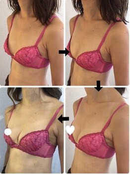 美人バスト 渋谷店/【バストアップ・育乳】◇症例◇