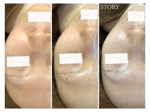 ストーリー(STORY)/ハーブピーリング専門店STORY