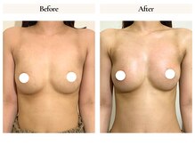 サロンドローヴ(Salon de LOAVE)/バストアップ症例