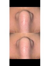 ルククギフ 岐阜(〇△□rukuku)/毛穴洗浄　全顔　nagisa