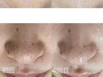 サロンドジェシカ(salon de Jessica)/プラズマ+ハーブピーリング