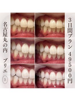ブリエ(BRILLER)/高効果ホワイトニング３日間