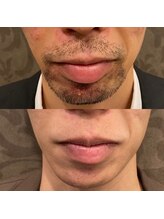 フェリーバ(FELIVA)/お肌の荒れも良くなります