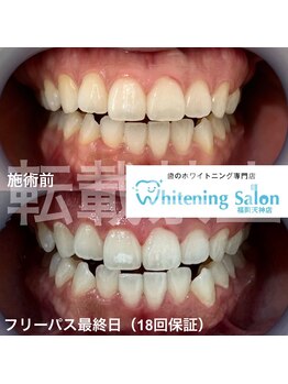 ホワイトニングサロン 福岡天神店/ホワイトニング