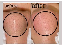 毛穴専科/ワックス脱毛メンズok/沖縄/那覇