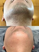 ジョア(XOHA)/ヒゲ脱毛/初回施術3週間後