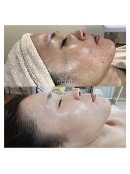 エクラ(eclat)/マーメイドセルトリートメント