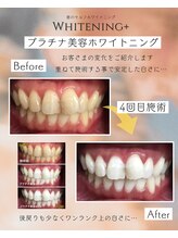ホワイトニングプラス(Whitening+)/見て見てこの白さ!!