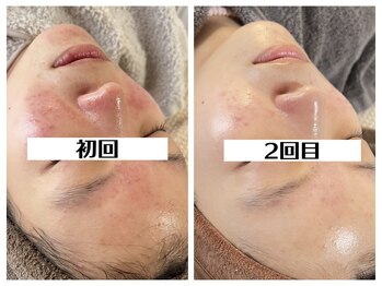 ハオン(HAON)/ハーブピーリング/ニキビ/毛穴