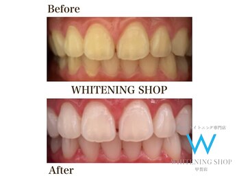 ホワイトニングショップ 甲賀店/Before&After『ホワイトニング』