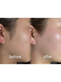 顔脱毛がしたい